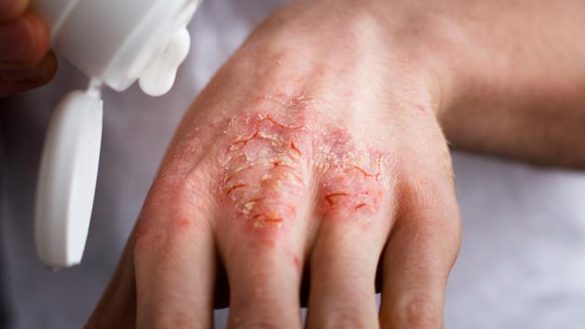 Eczéma : Comment le reconnaître